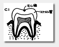 日本人の約90％以上がむし歯にかかっています。C1