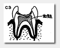 日本人の約90％以上がむし歯にかかっています。c3
