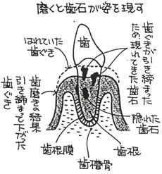 歯周病（歯槽膿漏-しそうのうろう-）とはどんな病気でしよう？