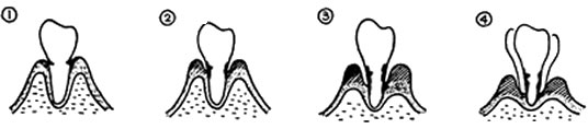 歯周病（歯槽膿漏-しそうのうろう-）とはどんな病気でしよう？