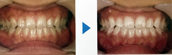 オゾンホワイトニング　症例1