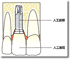 インプラント　画像